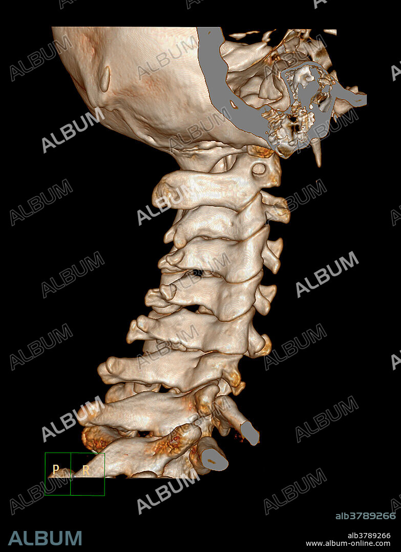This angled sagittal (from the side) CT reconstruction of the cervical spine demonstrates congenital fusion of C1 to the skull base with basilar invagination and platybasia.