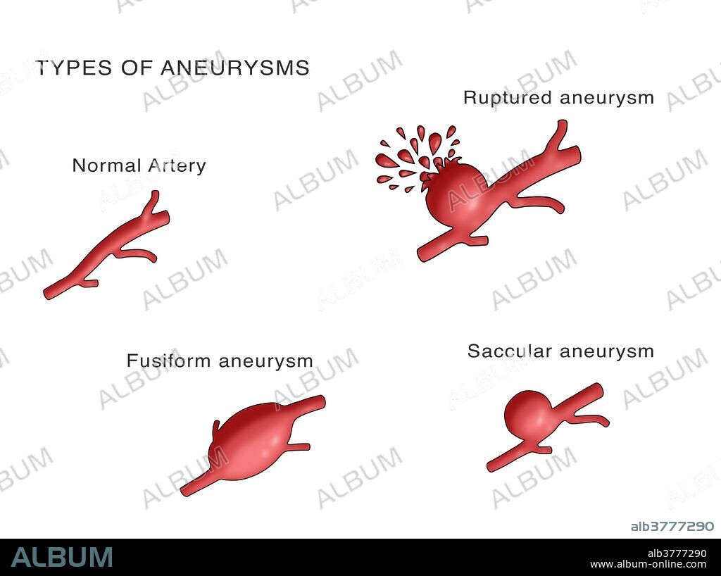 Types of Aneurysms