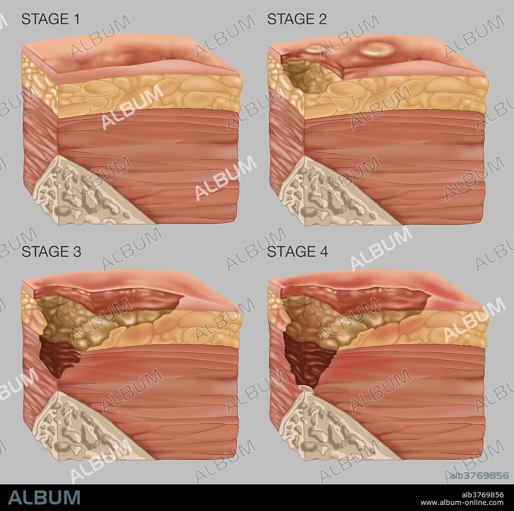 Illustration showing the 4 stages of a bedsore or pressure sore. Bedsores can be caused by many factors including unrelieved pressure, friction, humidity, etc. Bedsores usually afflict the frail and elderly, wheelchair bound people and the terminally ill. Bedsores can be fatal but can be treated and cured by a regimen of relieving pressure by turning the body on a strict schedule.