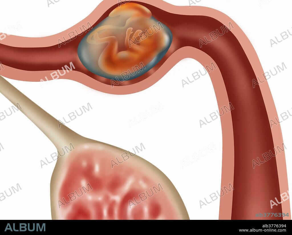Illustration of an ampulla ectopic pregnancy; a fetus growing in the ampulla (the second portion of the fallopian tube). An ampullar pregnancy is the most common type of tubal ectopic pregnancy. It accounts for about 70% of tube pregnancies.