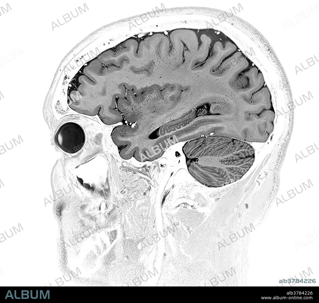 This sagittal (from the side) inverted T1-weighted MR image of the brain demonstrates the normal appearance of the hippocampus, insular lobe, and cerebellum in addition to other normal appearing brain structures.