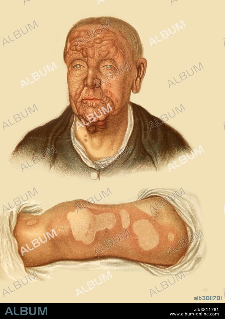 Elephantiasis Graecorum, true leprosy or Hansen's disease is a chronic bacterial infection. It is caused by the bacteria Mycobacterium leprae and lepromatosis. A person infected can be symptomless for years but also could suffer with granulomas (small tumours) affecting various parts of the body such as the skin and nervous system and also poorly pigmented patches of skin. It is a mildly contagious disease which can be treated with antimicrobial drug therapies. Chromolithograph, 1878-1888. Illustration by E. Burgess after R. W. Sherwin, Mabel Green and Jonathan Hutchinson.