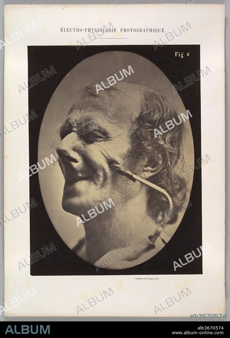 Figure 6: The grimice produced is similar to a tic of the face. Artist: Guillaume-Benjamin-Amand Duchenne de Boulogne (French, 1806-1875); Adrien Tournachon (French, 1825-1903). Dimensions: Image (Oval): 28.3 × 20.4 cm (11 1/8 × 8 1/16 in.)
Sheet: 29.8 × 22.4 cm (11 3/4 × 8 13/16 in.)
Mount: 40.1 × 28.6 cm (15 13/16 × 11 1/4 in.). Date: 1854-56, printed 1862.