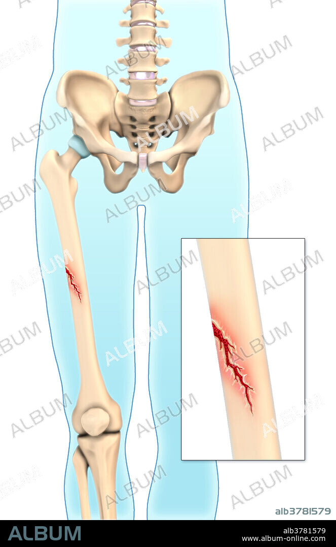 An illustration of a greenstick fracture in which an incomplete break occurs when a young, soft bone bends and breaks. This type of fracture is mostly seen in young children whose bones have not fully calcified and are somewhat flexible.