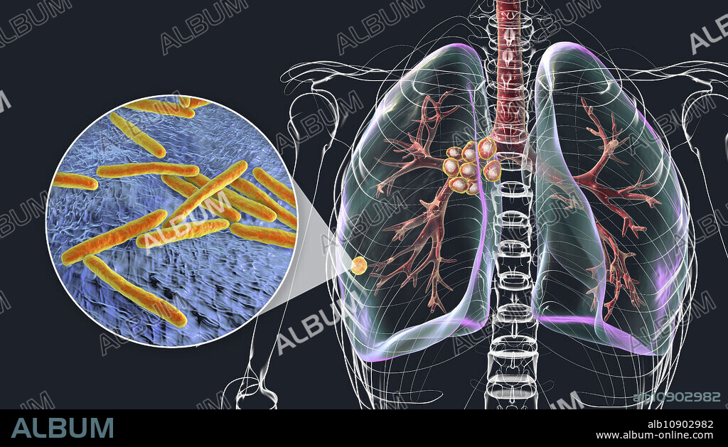 Illustration of primary lung tuberculosis with the Ranke complex, highlighting pulmonary lesions and mediastinal lymphadenitis with close-up view of Mycobacterium tuberculosis bacteria.