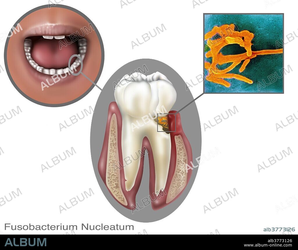 Fusobacterium nucleatum, oral bacteria found in the dental plaque of humans. Associated with the periodontal gum disease.
