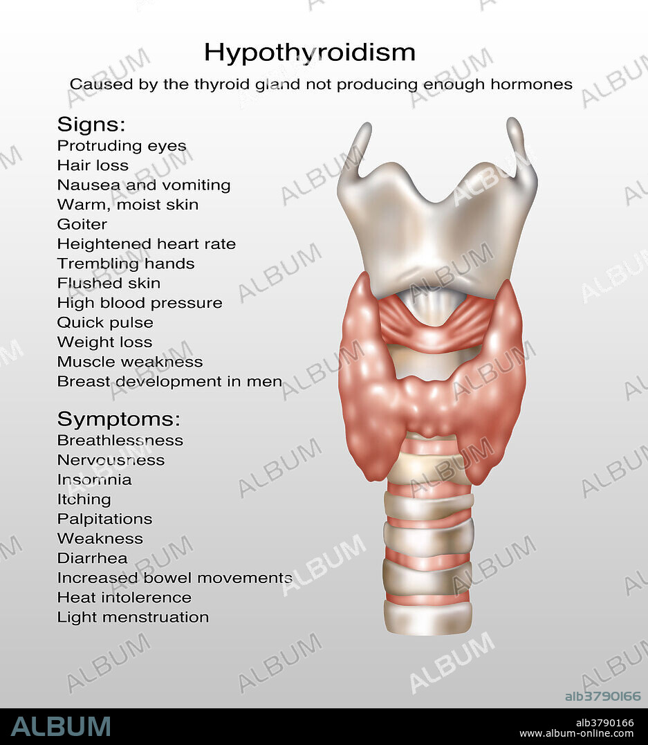 Hypothyroidism, Illustration