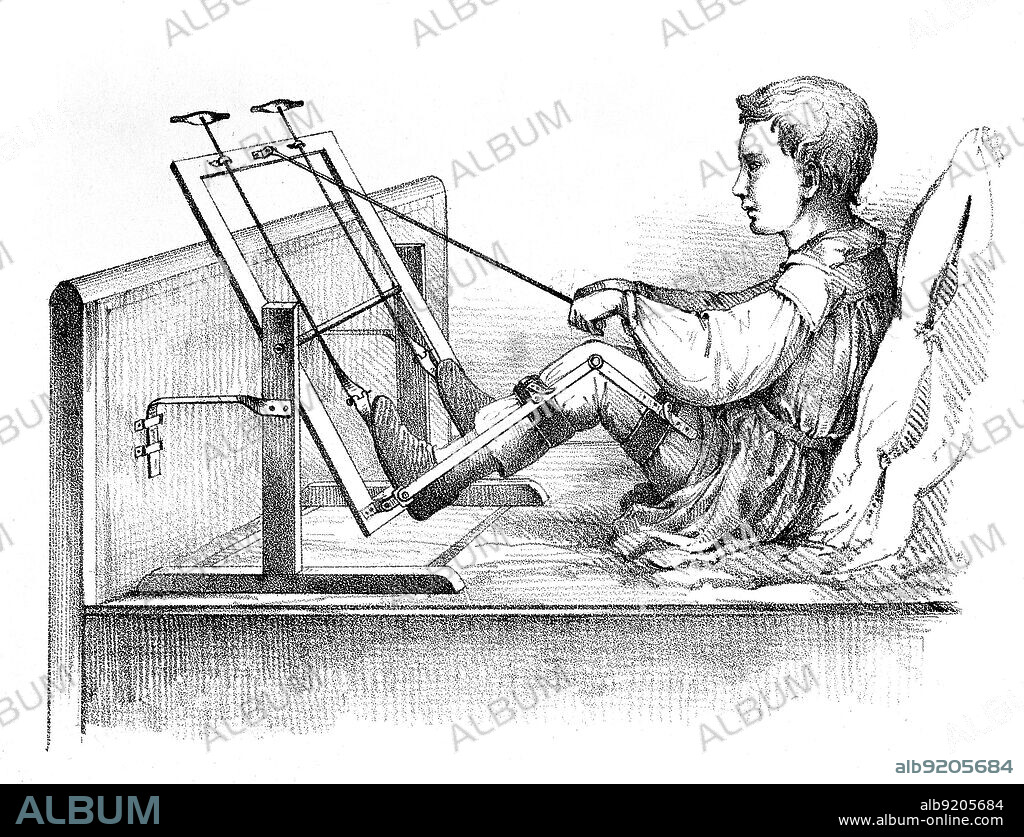 Illustration of paralysis due to polio. From "Observations on states of paralysis of the lower extremities and their treatment," by Jacob von Heine, 1840. The first clinical description of polio was by the English physician Michael Underwood in 1789, where he refers to polio as "a debility of the lower extremities." The work of physicians Jacob Heine in 1840 and Karl Oskar Medin in 1890 led to it being known as Heine-Medin disease. The disease was later called infantile paralysis, based on its propensity to affect children.