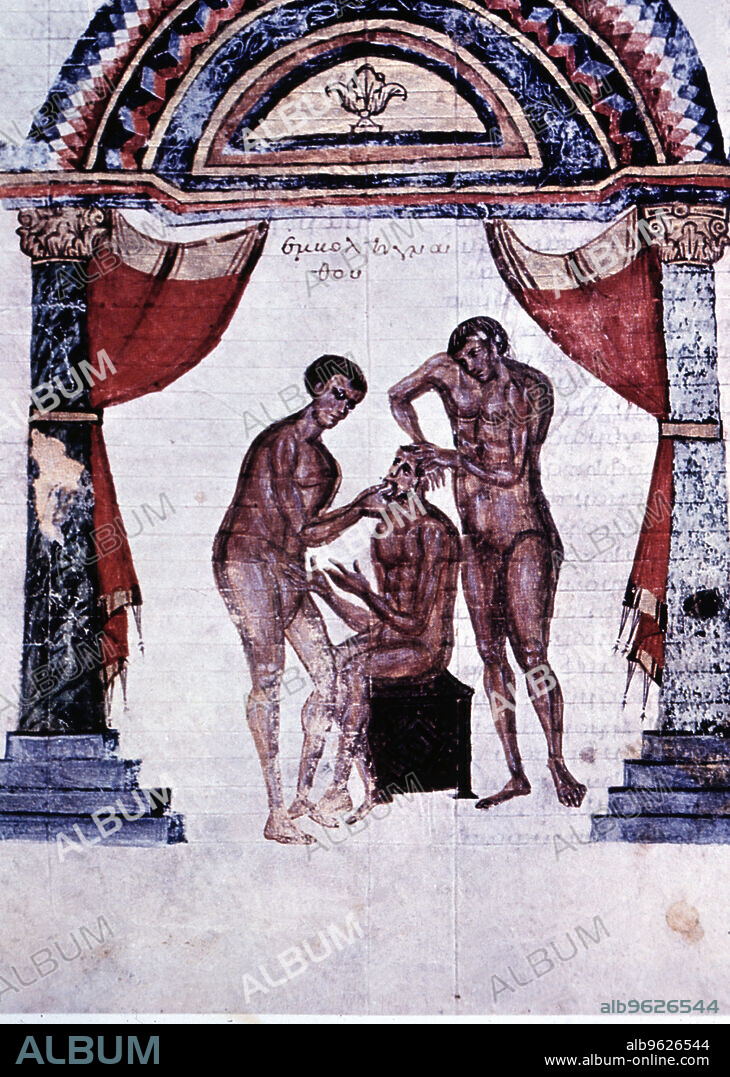 Mandibular reduction, miniature in the Surgery Codex in Comments of Apollonius, by Cizio the 8th century AD, 9th century copy.