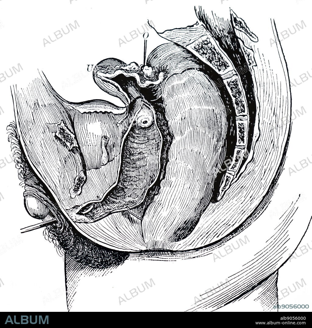 Hermaphroditism: On 20 August, 1864, a patient passing as a male entered the Hotel-Dieu, Paris, with pleurisy. They were identified as Marie-Madeline Lefort who had been examined at the Paris Faculty of Medicine in 1815. Passed first part of life as female and second part as male. From George M Gould and Walter L Pyle Anomolies and Curiosities of Medicine, Philadelphia, 1900. Mesial section showing the generative organs of Marie-Madeline Lefort.