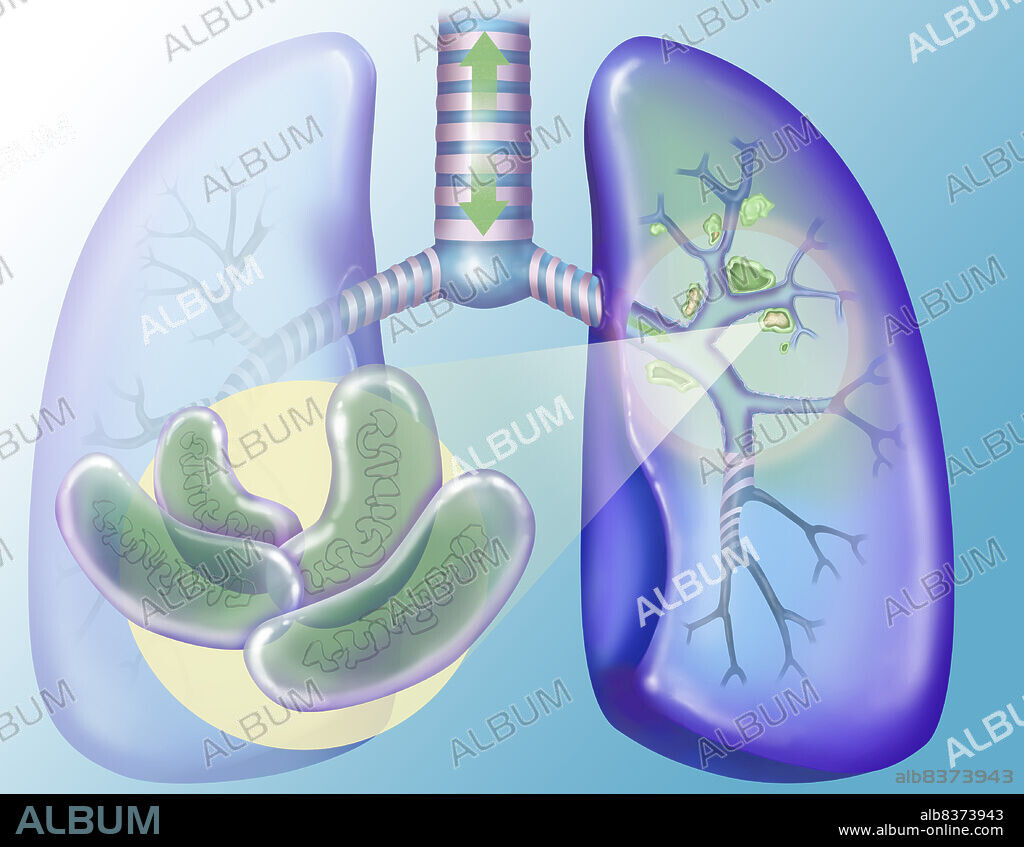 Pulmonary tuberculosis.. Kochís bacillus colonizes the lungs and develop by destroying the tissues, forming the focus(caseus material). These focuses calcify, constituting cavities, in which the bacteria multiply, and persist after healing.. Chez les patients for which the disease is declared, the bacillus present in the lungs can be expelled during the expiration and then infect other persons.. This image is part of a series on pulmonary pathologies.. See. images 0447007 and 0447307 for the healthy lung, 0445407 and 0445507 for the normal pulmonary circulation (heart, lungs and vessels), 0447407 and 0447507 for a symbolic representation of pulmonary pathologies, 0445607, 0445707, 0447107 and 0447207 for the lung cancer, 0445807, 0443807, 0446107, 0446207, 0446907, 0447607 and 0447707 for the pulmonary embolism, 0551407, 0551507, 0551607 and 0551707 for the tuberculosis.
