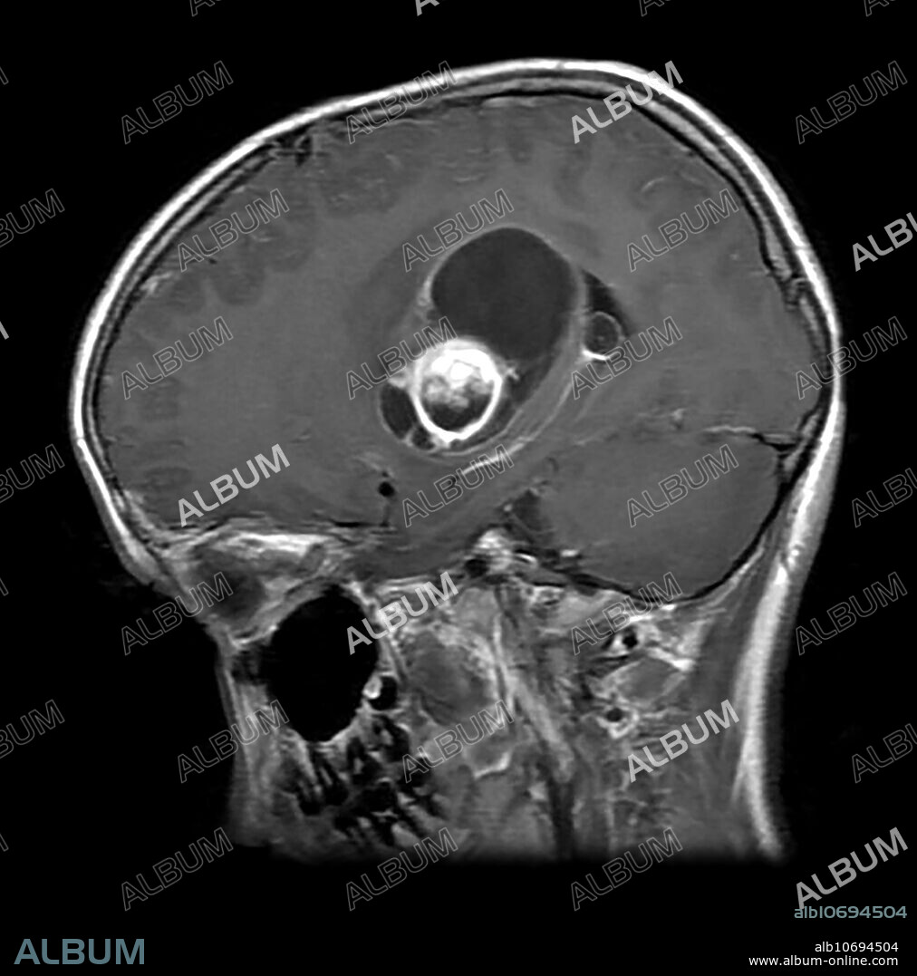 This axial (cross sectional) T1 weighted MR image with contrast shows a partially cystic and solid enhancing mass in the basal ganglia, internal capsule and thalamic regions with associate mass effect in a 25 year old. This represents a WHO grade 1 astrocytoma called a pilocytic astrocytoma.