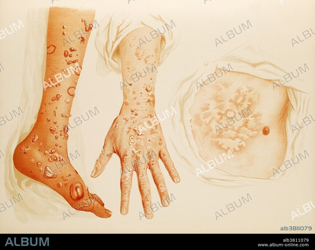 Hydroa Herpetiforme or Dermatitis Herpetiformis, hand, foot and chest. Far left: lower left leg and foot. Center: Back of left hand and lower arm. Right: abdomen and chest, showing blistering of the skin. H. Radcliffe Crocker, 1896. Dermatitis herpetiformis (DH), or Duhring's disease, is a chronic blistering skin condition, characterised by blisters filled with a watery fluid. Despite its name, DH is neither related to nor caused by herpes virus: the name means that it is a skin inflammation having an appearance similar to herpes.