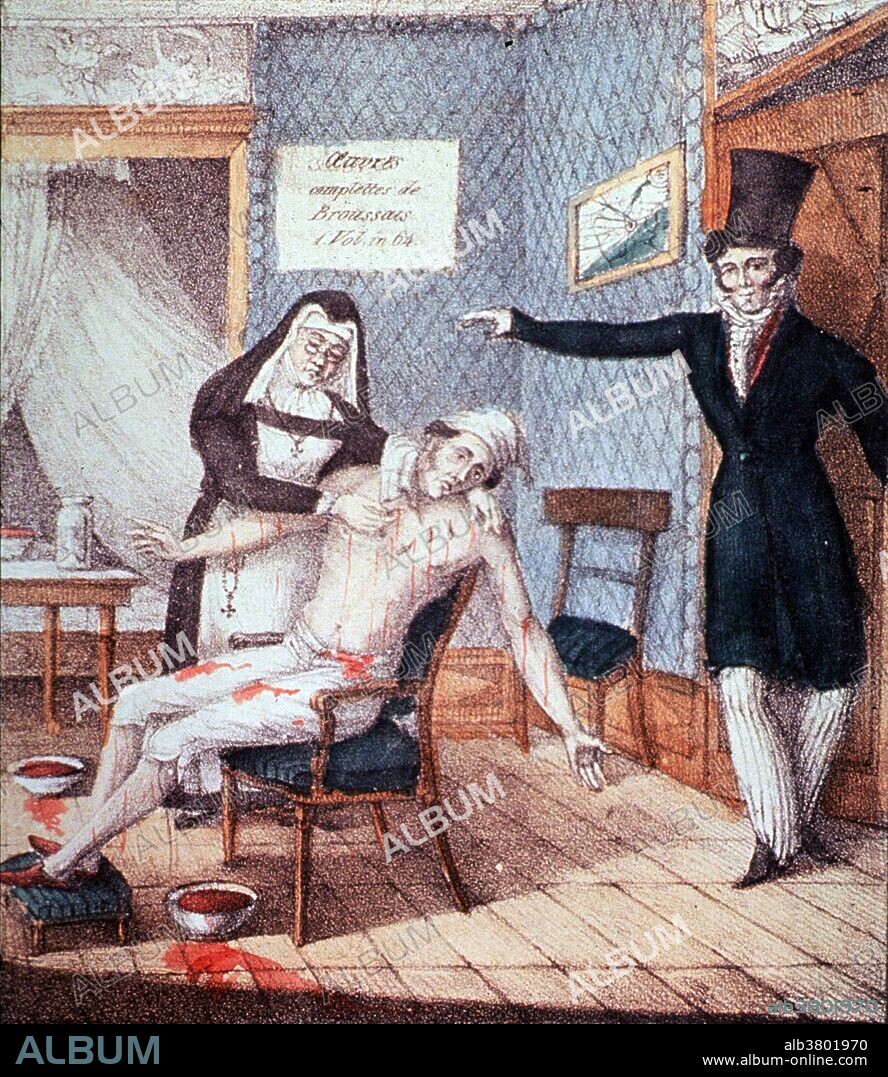 A man sitting in chair, arms outstretched, streams of blood pouring out as a nun places leeches on his body; a man (Broussais) stands in the doorway wearing top hat and coat; sign on the wall reads: Oeuvres complÃ¨tes de Broussais. Francois Joseph Victor Broussais (1772-1838), French physician whose advocacy of bleeding, leech treatments, and fasting dominated Parisian medical practice early in the 19th century. In 1816 he published his Examen de la doctrine medicale generalement adopte, (Review of the medical doctrine generally adopts) which drew down upon its author the wrath of the whole medical faculty of Paris, but eventually his doctrines triumphed. Late in life Broussais became an advocate and a patient of homeopathy and declared that orthodox medicine was 'more harmful than useful to humanity'. Bloodletting was based on an ancient system of medicine in which blood and other bodily fluid were considered to be "humors" the proper balance of which maintained health, but it often weakened sick patients. It was the most common medical practice performed by doctors from antiquity up to the late 19th century, a time span of almost 2,000 years.