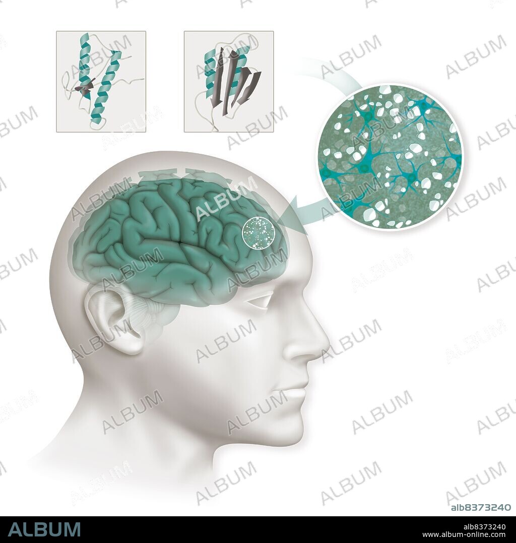 Illustration of prion diseases, or encephalopathies (Creutzfeldt-Jakob disease (CJD), fatal familial insomnia (FFI) and Gerstmann-Straussler-Scheinker syndrome (GSS)). The prion protein comes from a normal protein (left) which is present in mammals’ bodies. When this protein is badly conformed (right), and folds in on itself (“scrapie” prion protein (PrPsc)), accumulating in the brain, it causes a loss of neurons and the appearance of vacuoles in the encephalon, spongiosa and shrunken cortex.. This disease leads to a fatal degeneration of the central nervous system.