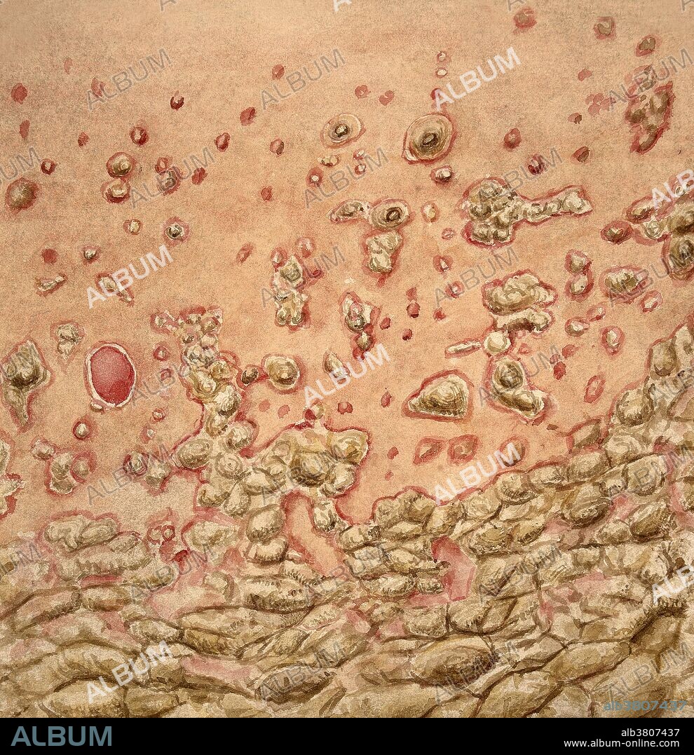 Watercolor drawing of a portion of the skin of the chest of a boy, aged 15 years, who suffered from very severe psoriasis. The lower part of the trunk, both in front and behind, and also his limbs were covered with thick grayish-yellow crusts. When these were picked off, a bright red raw surface remained. One of these patches is represented on the left. Illustration by Leonard Mark, 1891.