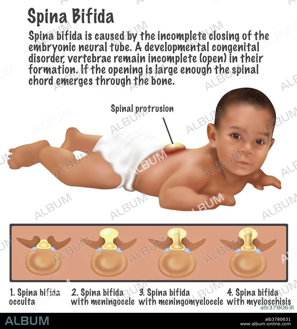 An illustration of a baby with Spina Bifida. Spina bifida is caused by the incomplete closing of the embryonic neutral tube. A development congenital disorder, vertebrae remain incomplete (open) in their formation. If the opening is large enough the spinal chord emerges through the bone. 1 baby in 30 is born with one or more major birth defects. Most are correctable with modern surgery.