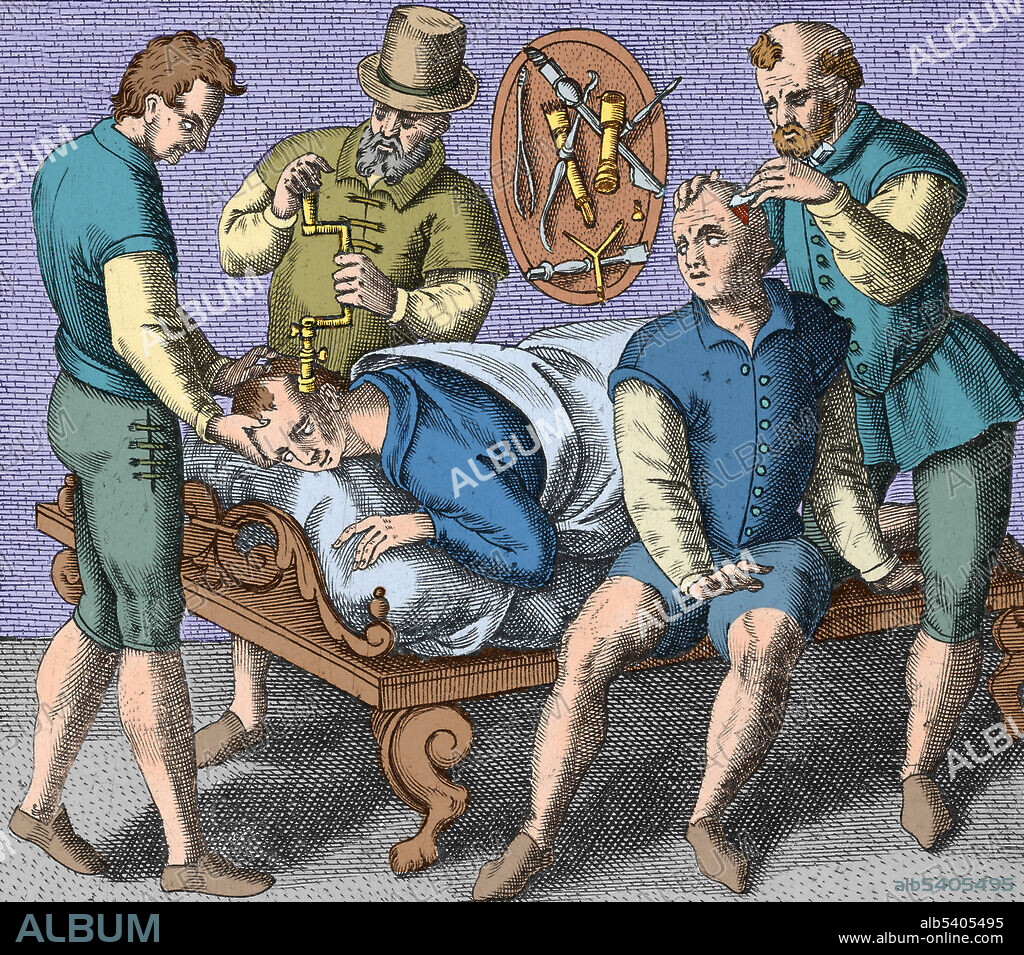 Trepanning Being Performed, 1594