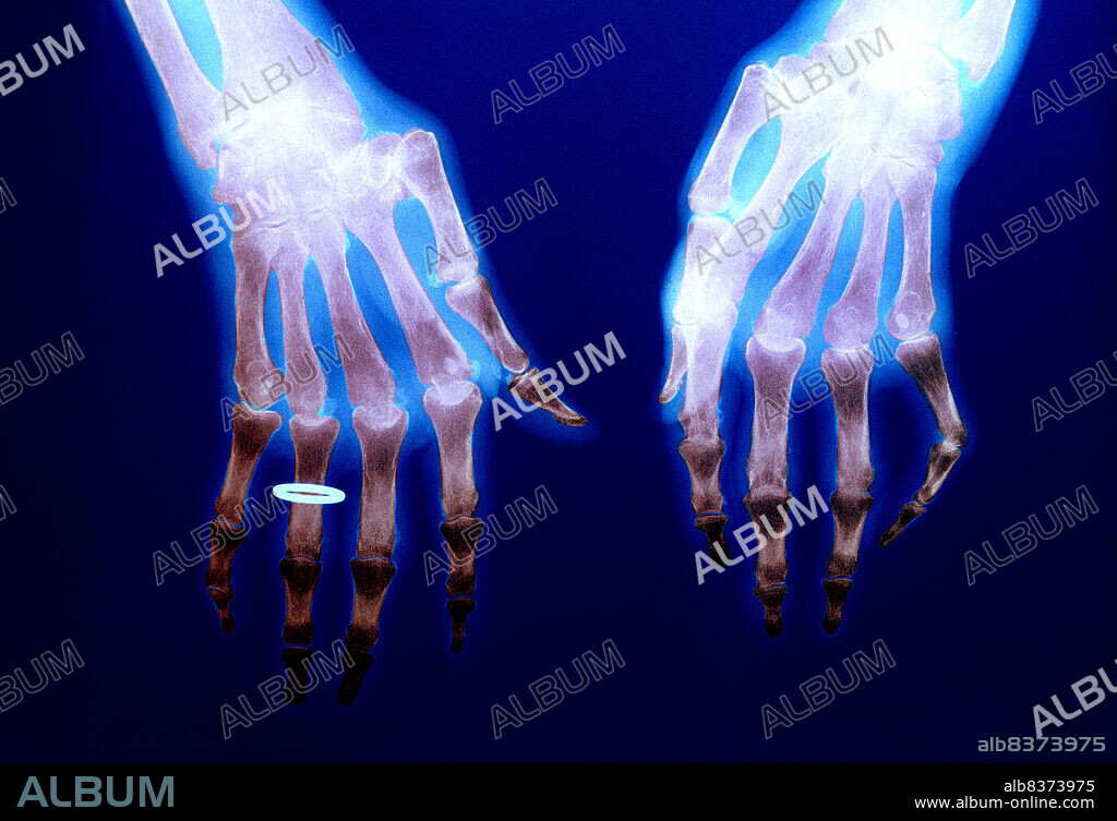 Rheumatoid arthritis is an inflammatory disease which can affect several joints at the same time. The disease leads to deformations easily recognized on the x-ray. The disease commonly affects the hands, the feet and the knees. Rheumatoid arthritis is more frequent in women. X-ray of hands.