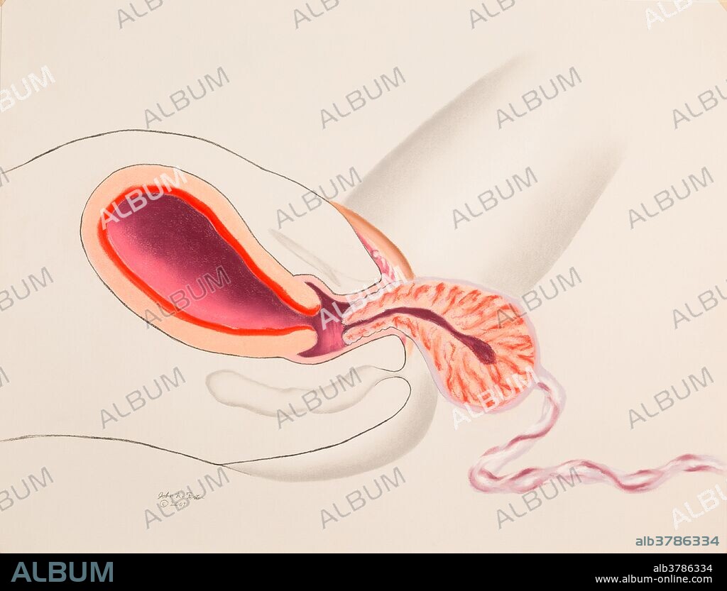Placenta Delivery, Childbirth, 5 of 5