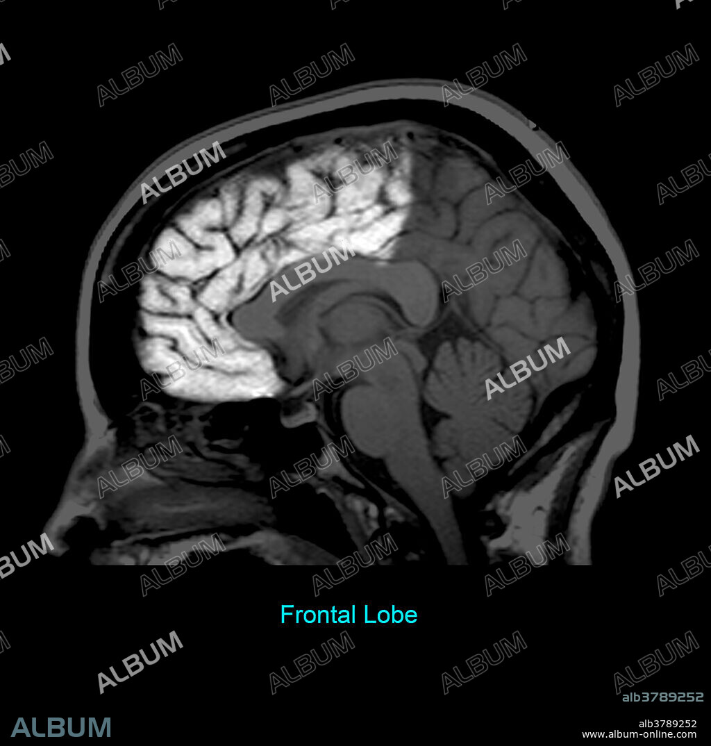 This T1 weighted sagittal (from the side) image of the brain highlights the frontal lobe.