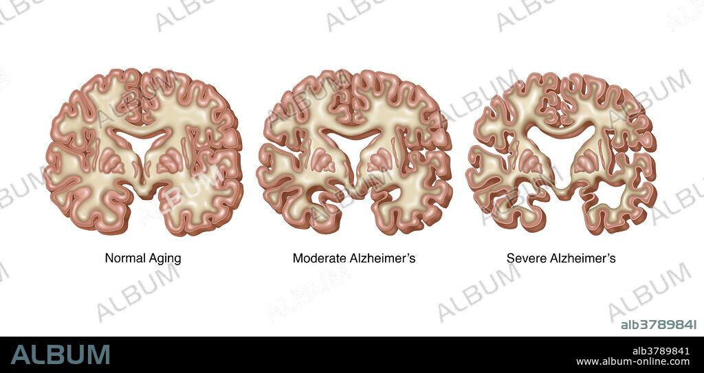 Illustration showing a cross section of brain with three degrees of deterioration. From left to right, normal aging brain, moderate deterioration, and extreme deterioration. The later two representing alzheimer's disease.