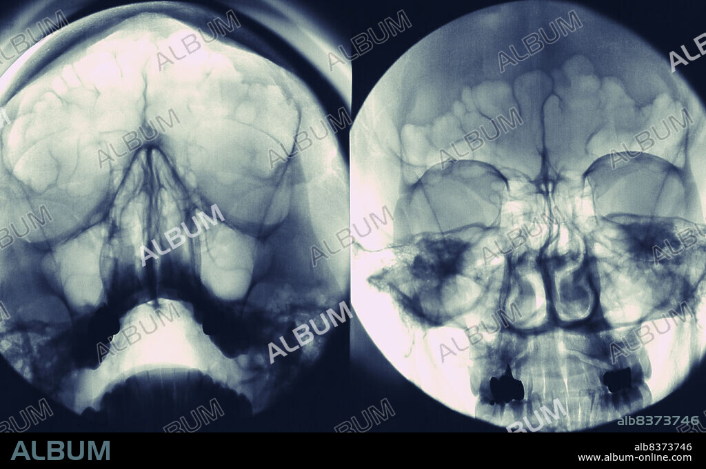 Sinus of the face. High-face incidence (left) and incidence of Blondeau (right). Maxillary sinuses and normal frontal sinuses.