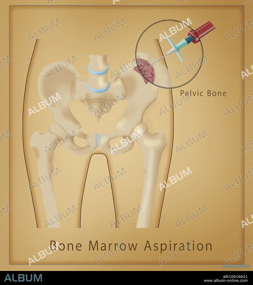 Diagram of hip bone marrow aspiration with a needle, medical illustration