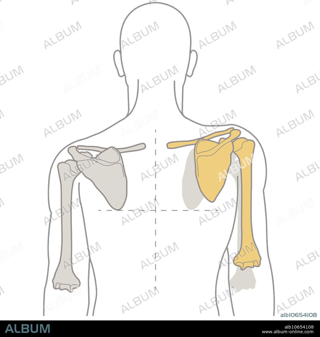 Scapular dyskinesis is an abnormal shoulder blade movement, often due to muscle imbalances, leading to pain, reduced function, and altered shoulder mechanics, commonly addressed through rehabilitation. Illustration.
