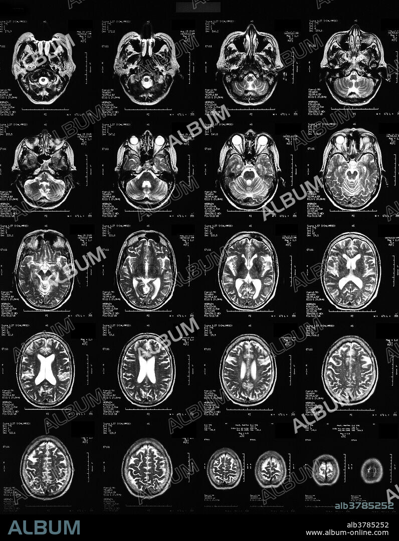 Normal MRI of the brain of a 62-year-old female patient.