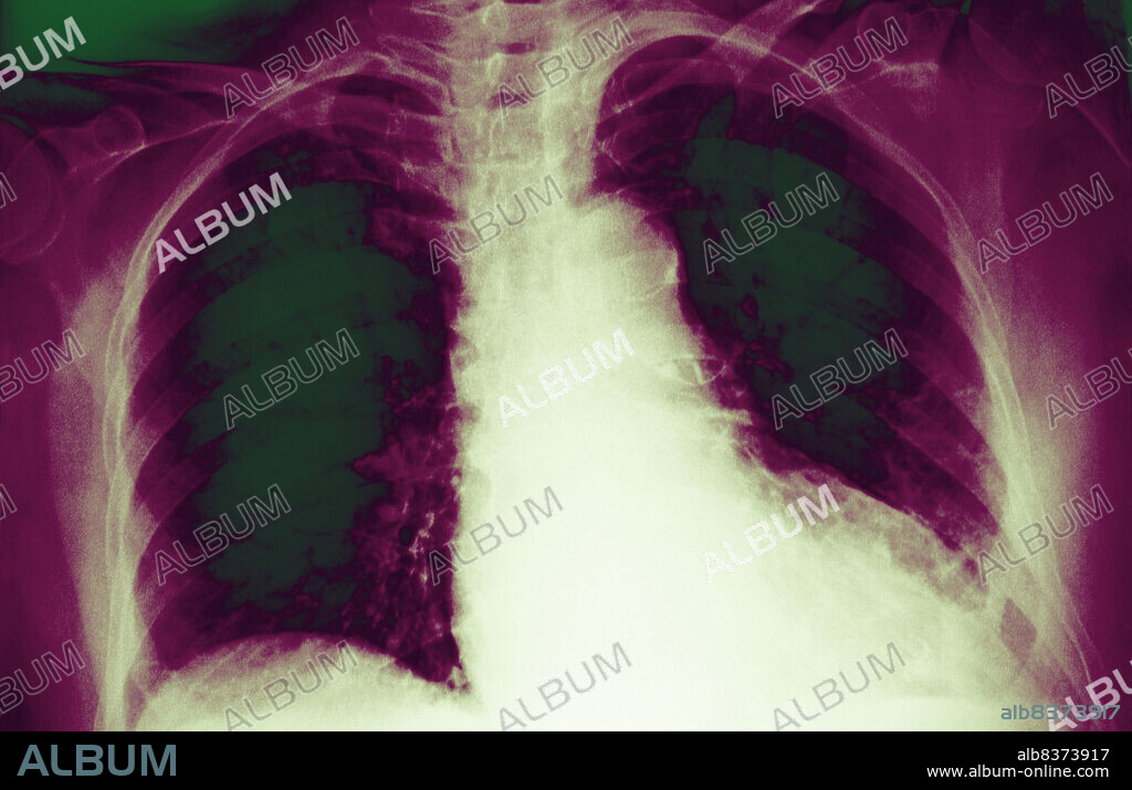 Cardiomegaly is an enlargement of the heart due to dilatation of the heart cavities. This can result from many conditions including a disease of the heart muscle (myocardial disease), defective valve function, or hypertrophy of the heart muscle due to stenosis of the aortic valve. Pericardial effusion (fluid collection in the fibrous envelope of the heart) can also lead to considerable cardiomegaly visible on the x-ray. Left untreated, cardiomegaly can lead to heart failure characterized by dyspnea (difficulty breathing) and edema of the lower limbs.