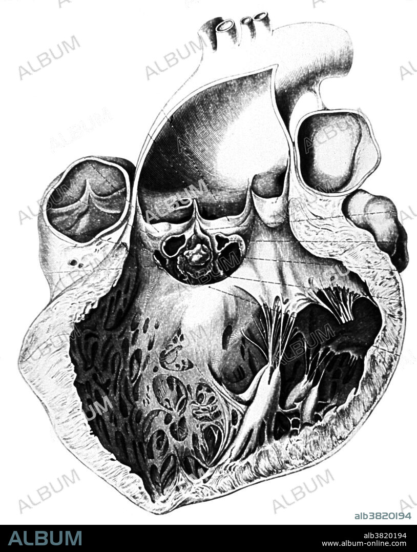 Cardiovascular system created by von Rokitansky for his pathological and anatomical treatise, Die Defecte der Scheidewande des Herzens, 1875. Carl von Rokitansky (February 19, 1804 - July 23, 1878) was a Bohemian physician, pathologist, humanist philosopher and liberal politician. As a young professor, he recognized that the discipline of pathological anatomy could be of great service to clinical work in the hospital, because it could offer new diagnostic and therapeutic possibilities to the bedside physician. His name is associated with many diseases/morphologic features of disease. He developed a method of autopsy which consisted mainly of in situ dissection, and is said to have supervised 70,000 autopsies, and personally performed over 30,000, averaging 2 a day, 7 days a week, for 45 years. He believed scientists should first regard humans as conscious and free-willing subjects and only then follow their urge toward knowledge. The feeling of humanity would be lost if physicians regarded human beings purely as research objects. Thus Rokitansky brought up for the first time the question of ethics in medicine. He helped to shape the era of Austrian high liberalism. He died in 1878 at the age of 74.