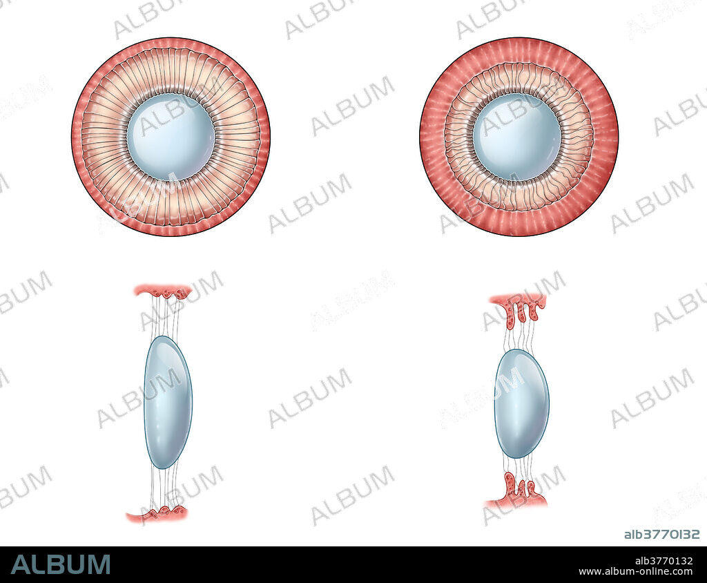 An illustration depicting the accommodation of the lens as the eye focuses on near or distant objects. Ciliary muscle contractions, taking place inside the eye, control the shape of the lens. The image on the left shows the ciliary muscles relaxing to increase tension of the suspensory ligaments and keep the lens flattened to focus on distant objects. On the right, the ciliary muscles contract, causing the suspensory ligaments to relax and allow the lens to form a rounder shape and increase its refractive power to focus on nearby objects.