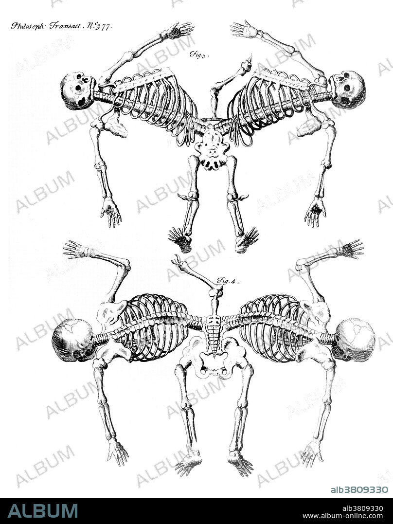 Conjoined twins are identical twins born with their bodies joined at some point and having varying degrees of residual duplication, a result of the incomplete division of the ovum from which the twins developed. Ischiopagus twins have fused lower half of the two bodies, with spines conjoined end-to-end at a 180 degree angle. These twins have four arms; two, three or four legs; and typically one external set of genitalia and anus. Image appeared in "Philosophical transactions", Volume 31-32 Number 377, Firgure 3 & 4, published 1720-23.