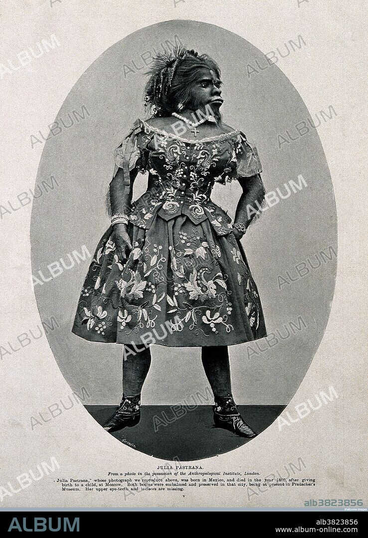 Julia Pastrana (1834 - March 25, 1860) was a woman born with hypertrichosis, who took part in 19th century exhibition tours in North America and Europe. She was born with a genetic condition, hypertrichosis terminalis, her face and body were covered with straight black hair. Her ears and nose were unusually large, and her teeth were irregular. The latter condition was caused by a rare disease, undiagnosed in her lifetime, Gingival hyperplasia, which thickened her lips and gums. She was advertised as a hybrid between an ape and a human, and as a "Bear Woman". During a tour in Moscow, Pastrana gave birth to a baby with features similar to her own. The child survived only three days, and Pastrana died of postpartum complications five days later. Hypertrichosis (also called Ambras syndrome) is an abnormal amount of hair growth over the body. Extensive cases of hypertrichosis have informally been called werewolf syndrome, because the appearance is similar to the werewolf.