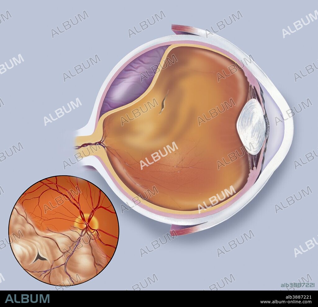 Diagram of a retinal detachment.
