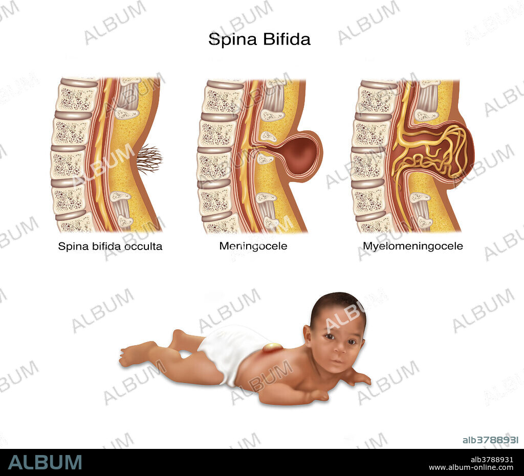 An illustration of the different types of Spina bifida and a baby with spina bifida. Spina bifida is caused by the incomplete closing of the embryonic neutral tube. A development congenital disorder, vertebrae remain incomplete (open) in their formation. If the opening is large enough the spinal chord emerges through the bone. 1 baby in 30 is born with one or more major birth defects. Most are correctable with modern surgery.