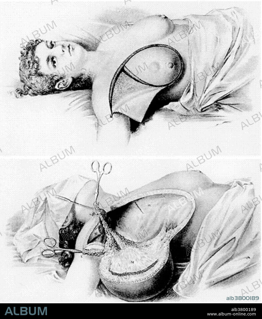 Illustration of the Halsted incision and final cut. In 1882 the American surgeon William Halsted first performed what would become known as the Halsted Mastectomy, which involves removal of the entire breast, area lymphatic tissue, and the pectoralis muscle. Halsted achieved a 5-year cure rate of 40% through a number of innovations: his aggressive approach to tissue removal, his use of the antiseptic techniques introduced by Joseph Lister, and his introduction of the use of rubber gloves.