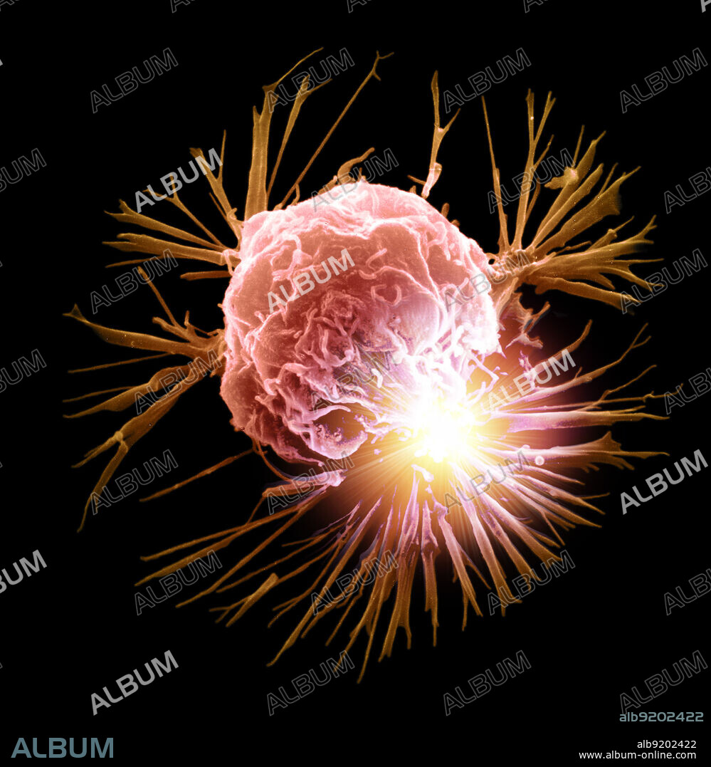 Conceptual digital illustration of a breast cancer cell undergoing laser treatment. Laser therapy uses high-intensity light to treat cancer and other illnesses. Lasers can be used to shrink or destroy tumors or precancerous growths.