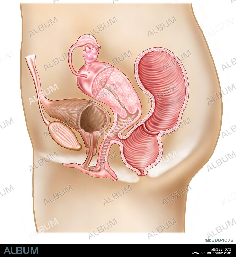 Rectovaginal fistula and cross section of female reproductive organs with rectum cross section.