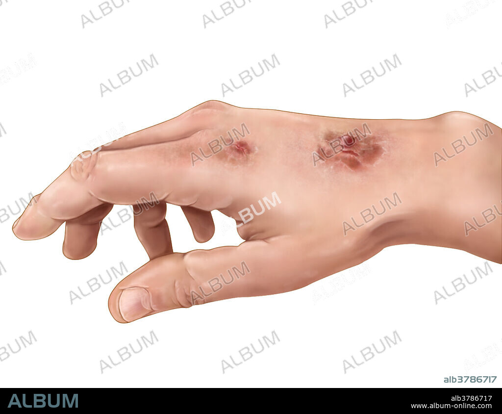 An illustrated view of the hand depicting squamous cell carcinoma, a skin cancer arising from the uncontrolled division of squamous epithelial cells in the epidermis. Symptoms include the appearance of reddish lesions or raised ulcers that may form a hard, plaque-like surface, and usually develop slowly. Areas which are commonly affected are those which have high or frequent sun exposure, such as the back of the hand, scalp, lip or nose. Treatment usually requires surgery to remove the cancerous areas before they metastasize.