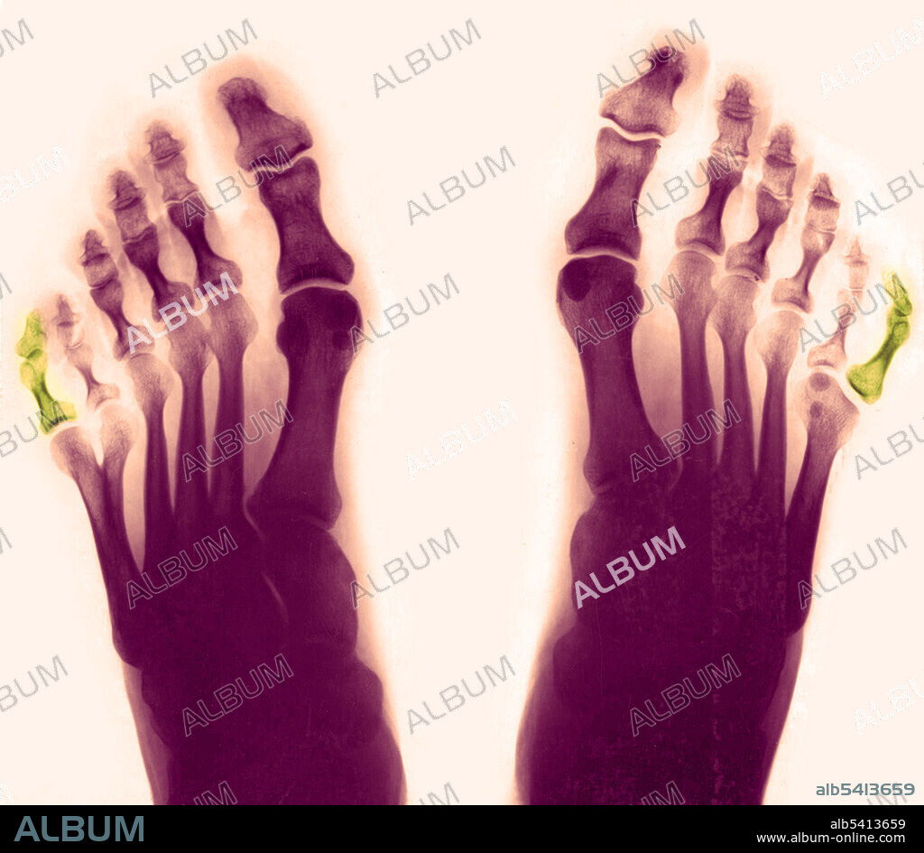 X-ray of feet, showing postaxial polydactyly. Polydactylism is the congenital abnormality of having extraneous fingers or toes. As visible above, this individual had six toes on both feet. This is an example of postaxial polydactyly, because the extra digit occurs on the pinky side of the foot.