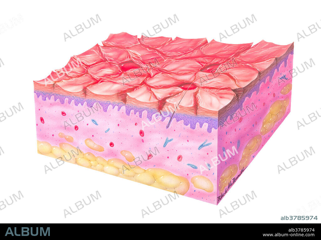 Illustration of asteatotic eczema. This skin condition is characterized by dry, reddened skin, with fine cracks. This can cause itching and pain.