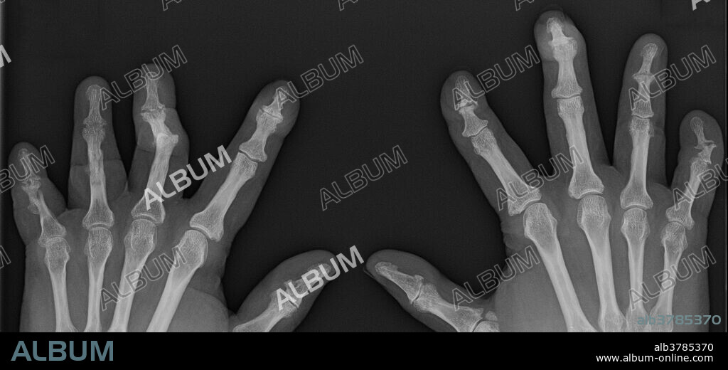 X-ray of the hands of a 58 year old female with psoriatic arthritis. Radiographs reveal sausage digits with severe erosive deformities of the interphalangeal joints, bone production, pencil in cup deformities, ankylosis, and subluxations.