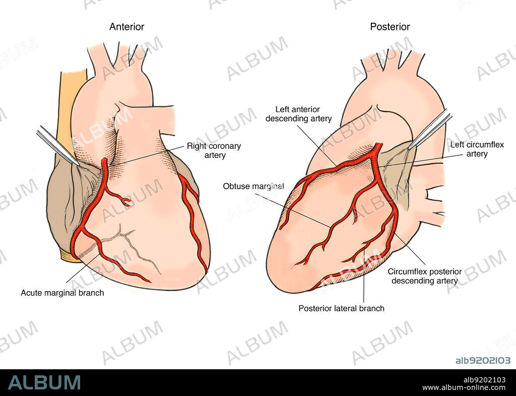 Anatomical illustration of the arteries of the heart, showing (on anterior) right coronary artery, acute marginal branch, and (on posterior) left anterior descending artery, obtuse marginal, left circumflex artery, circumflex posterior descending artery, and posterior lateral branch.