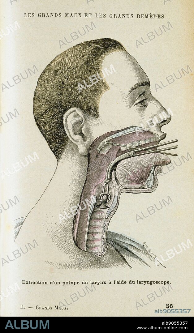 Using a laryngoscope to aid a surgeon in the removal of a polyp from the throat, c1890. A small mirror on a long metal handle was invented in 1854 by a Spanish singing teacher Manuel Garcia (1805)- 1906) to study the vocal chords. In 1858 Ludwig Turck (1810-1868) and Johann Czermak (1828-1873) both published papers on use of the instrument, but Czermak invented a headband mirror to throw light on Laryngoscope mirror, an so on the throat. From 'Les Grands Maux et les Grands Remedes' ('The Principal Illnesses and Their Remedies'), Jules Rengade, (Paris, c1890).