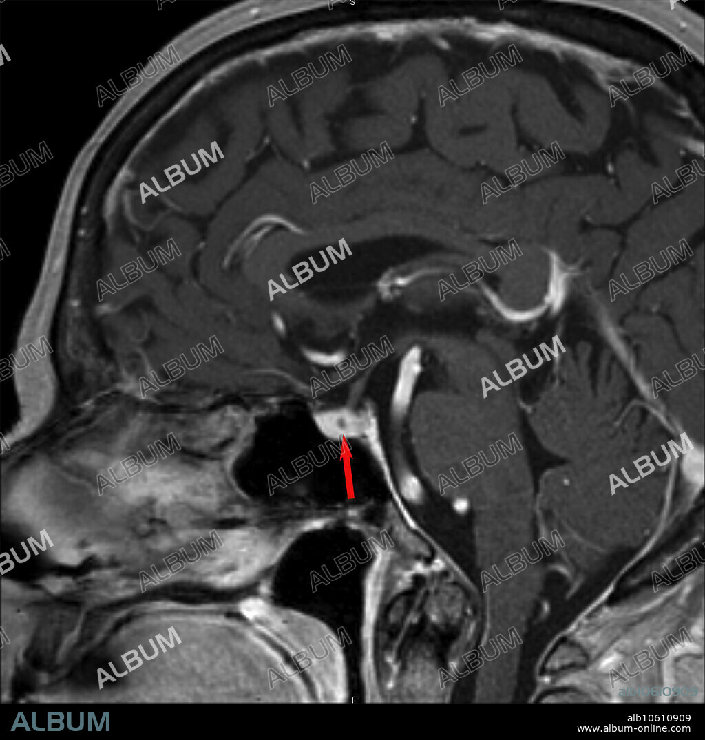 78 year old female with abnormal hormone levels (hyperprolactinemia). 3.0T MRI of the sella turcica reveals a 2mm non-enhancing, cystic lesion in the right side of the pituitary gland consistent with microadenoma. 2 mm post gadolinium sagittal T1 image.