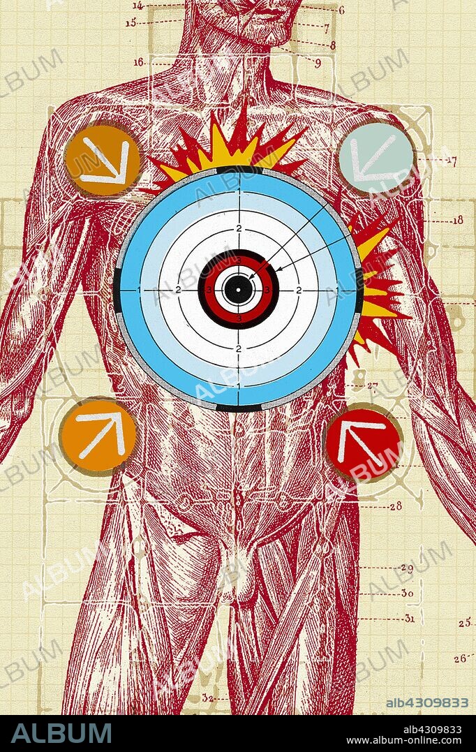 Arrows and bull’s-eye over male anatomical model.