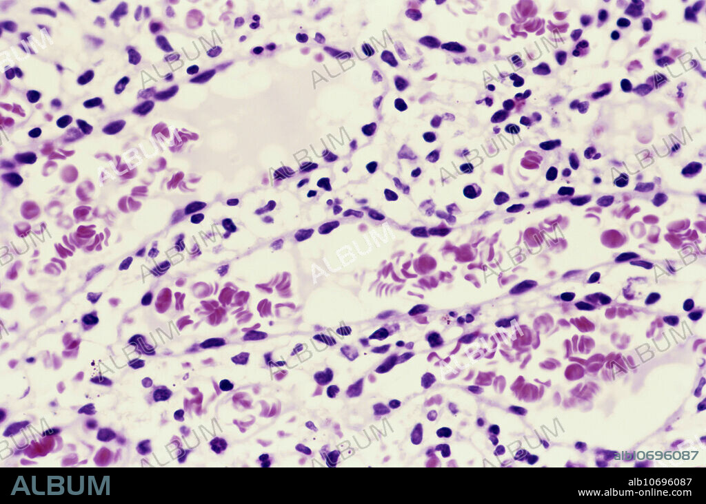 Light micrograph of a section of human spleen, showing cords of Billroth (also called splenic cords or red pulp cords). Magnification unknown. The spleen removes debris from blood, produces immunological responses, and removes defective red cells.