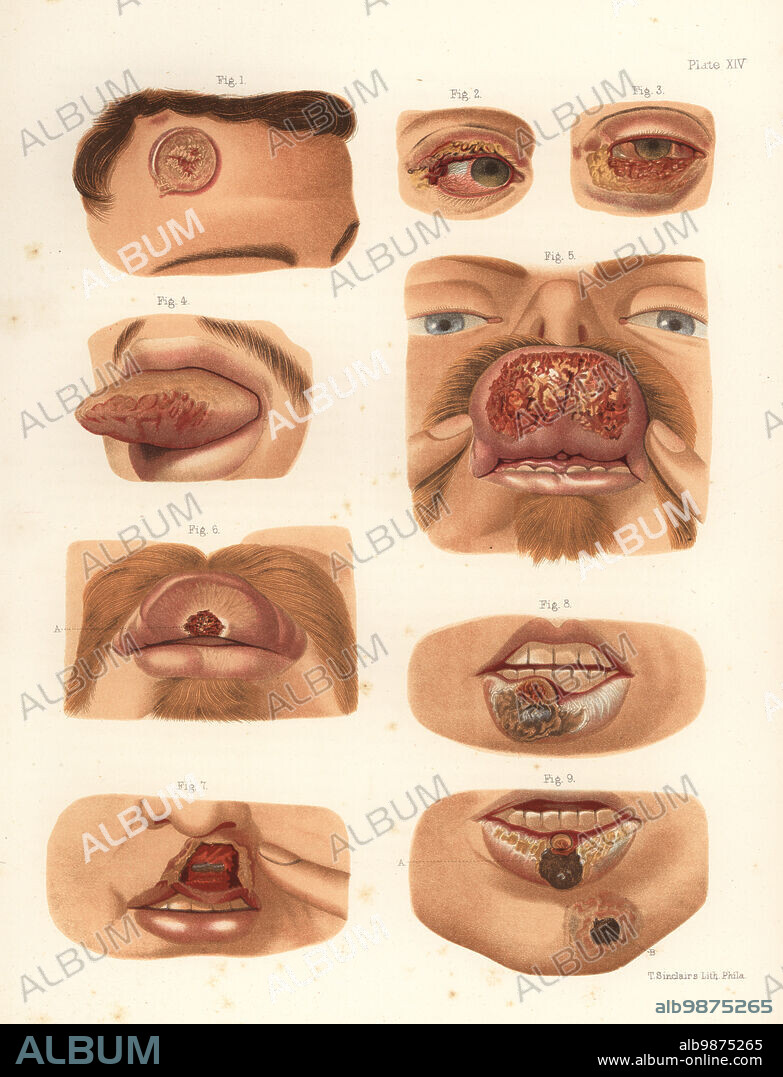 Syphilitic chancres on the face. Indurated chancres to the forehead, eyelids, tongue and lips, and ecthymatous chancre to the chin. Chromolithograph by T. Sinclaire from Freeman J. Bumsteads Atlas of Venereal Diseases, Henry C. Lea, Philadelphia, 1868. First American edition of Auguste Culleriers Precis iconographique des maladies veneriennes. Chromolithograph by T. Sinclaire from Freeman J. Bumsteads Atlas of Venereal Diseases, Henry C. Lea, Philadelphia, 1868. First American edition of Auguste Culleriers Precis iconographique des maladies veneriennes.